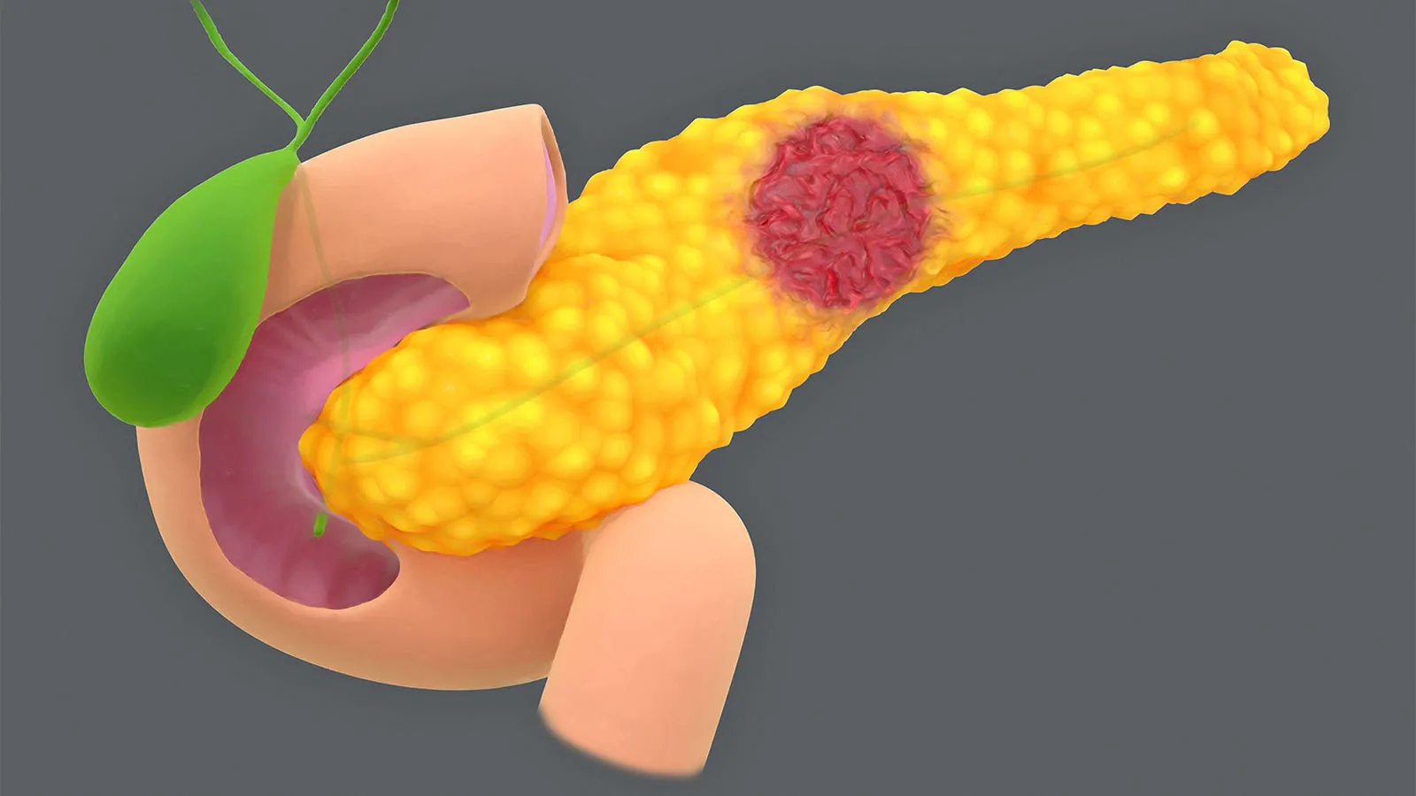 More worrisome features in pancreatic cysts = much higher cancer risk