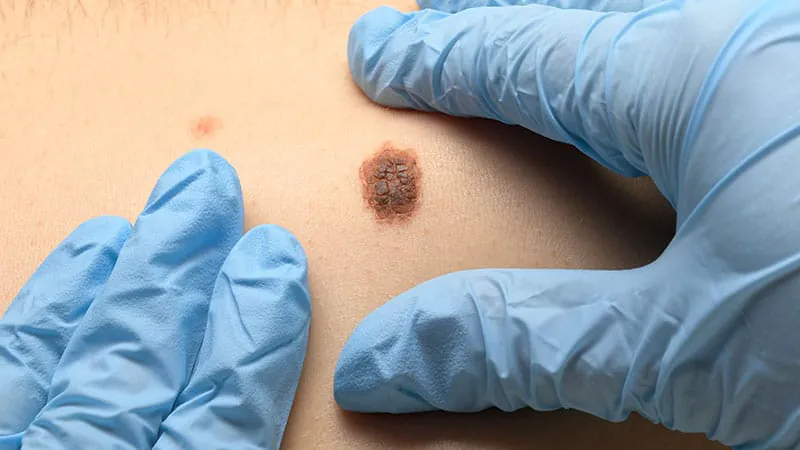 Skin cancer apps didn't boost detection — but they did fill waiting rooms