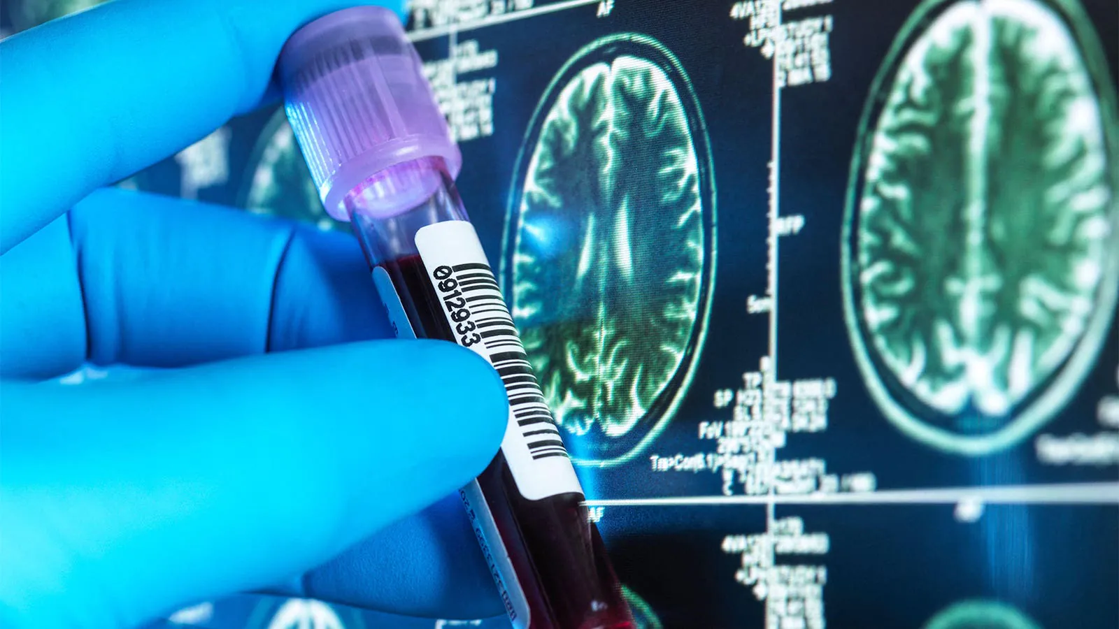 FDA clears first Alzheimer's blood test for adults as young as 40
