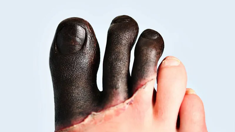 Older adults and socially exposed patients face the highest risk of serious outcomes from frostbite