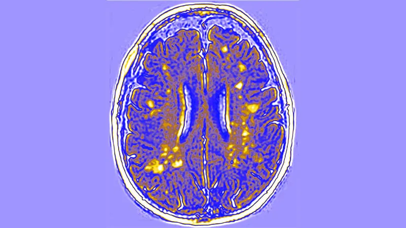 Old blood pressure drug shows promise as first disease-modifying treatment for rare childhood brain disorder