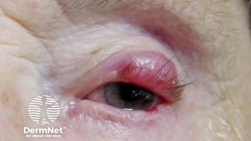 Blood test may catch Merkel cell cancer recurrence before scans do
