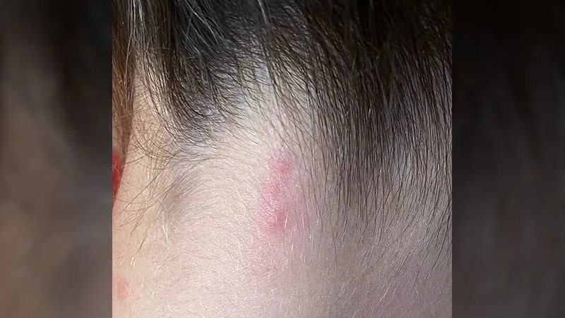 Bug bites, big consequences: A dermatologist's guide to diagnosing and treating insect bites