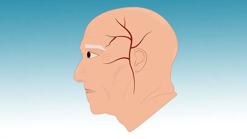 Giant cell arteritis patients stuck on steroids — and the risks keep adding up
