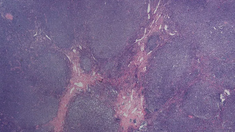 A promising combo therapy offers new hope for hard-to-treat mantle cell lymphoma