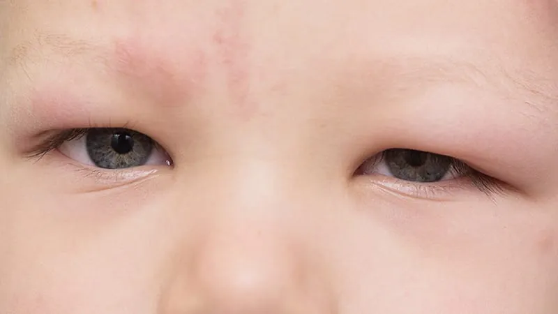 Youngest infants at higher risk for a dangerous second allergic reaction