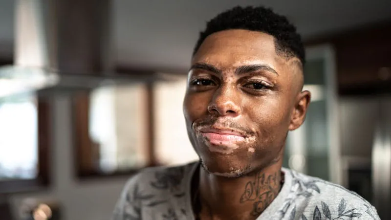 Ruxolitinib cream shows lasting repigmentation and mental health benefits in vitiligo patients