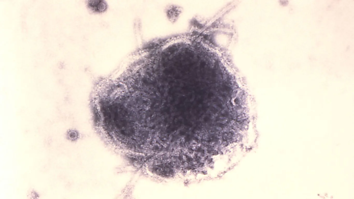 U.S. measles crisis deepens: First 2026 deaths reported as case count hits 35-year high