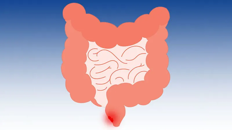 Long-course chemoradiotherapy outperforms short-course RT in preserving the rectum for low-risk rectal cancer