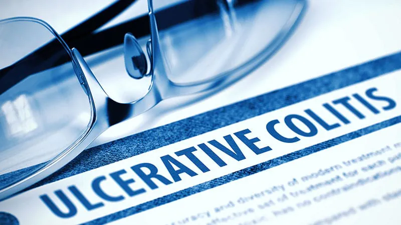 Upadacitinib pulls ahead in real-world ulcerative colitis showdown