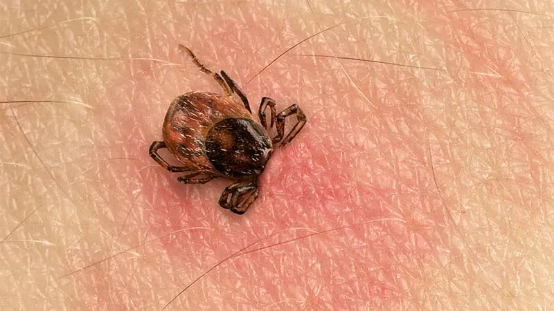 Lyme disease is rising — and prevention is struggling to keep up