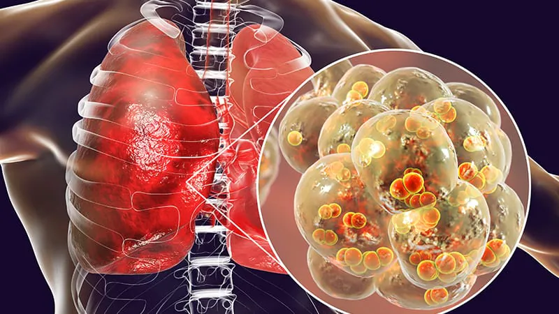 PCV13 cut pneumonia hospitalizations — but racial and income gaps remain stubbornly wide