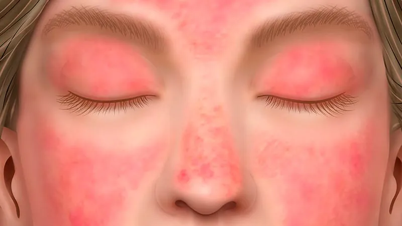Brepocitinib shows rapid, lasting skin relief in dermatomyositis patients
