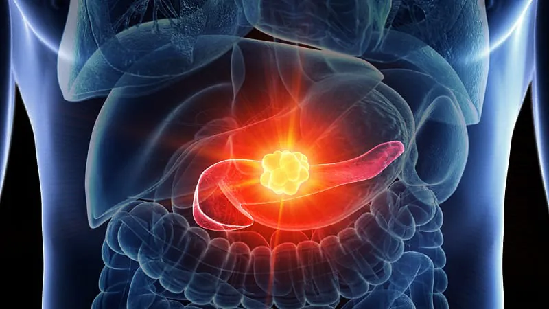 Adding radiation to chemo doesn't extend survival in pancreatic cancer — but one group may still benefit