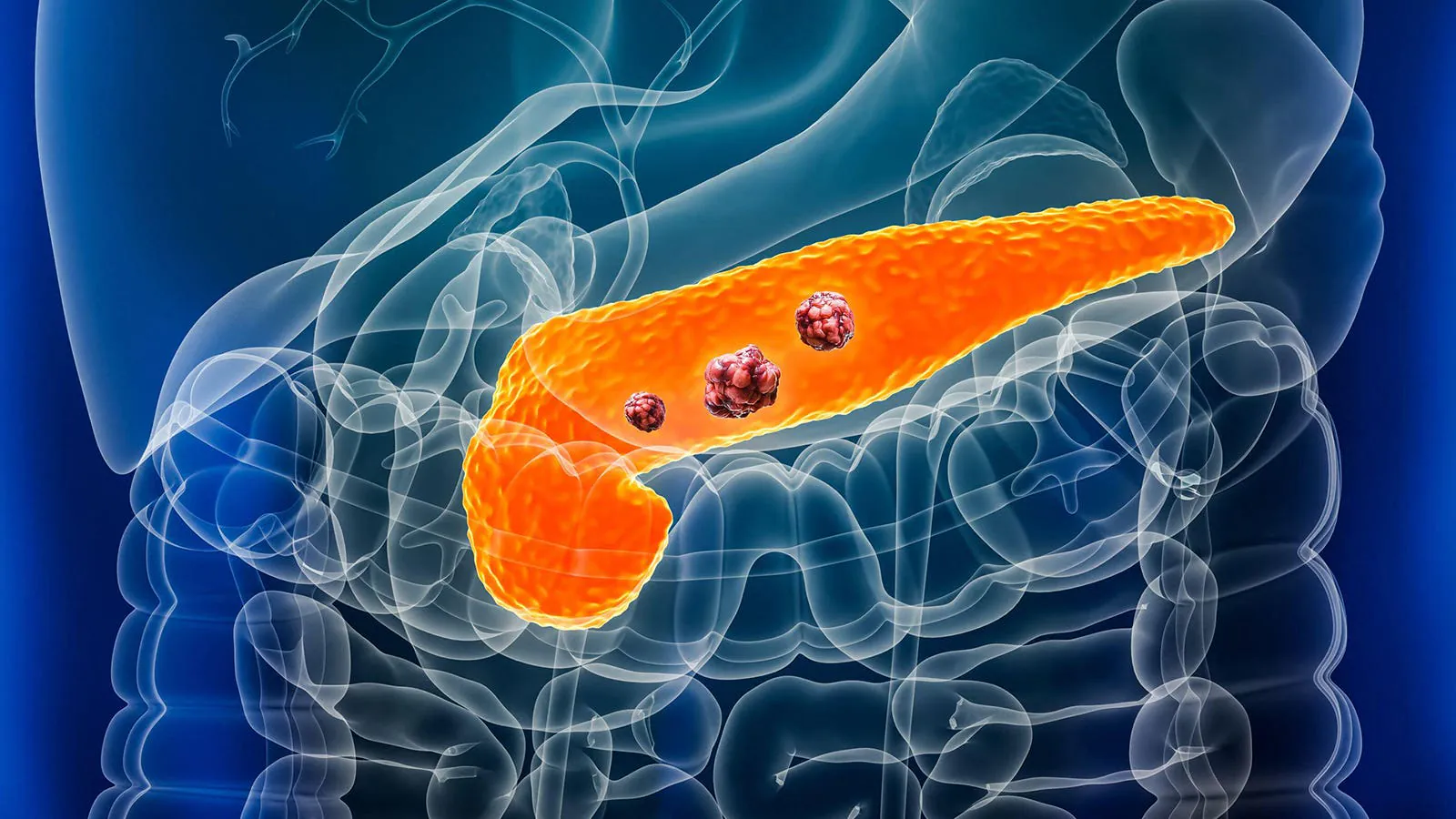 FDA approves daraxonrasib — a first-in-class drug that doubled survival in pancreatic cancer