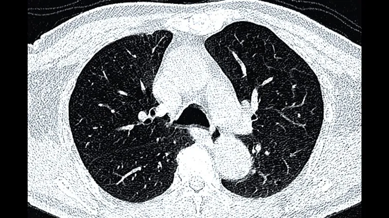 AI beats gene sequencing at spotting dangerous lung nodules