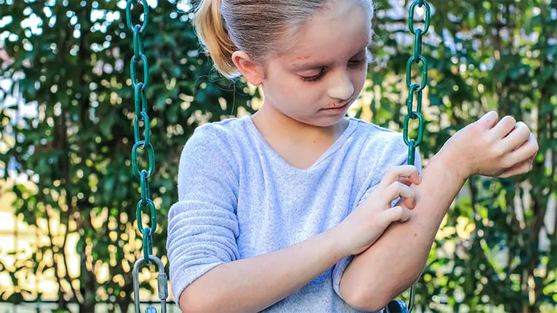 Childhood eczema may be stunting growth and inflating BMI, new study finds