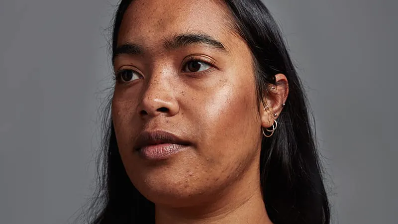 The "post" in postinflammatory hyperpigmentation may be misleading — especially for darker skin tones