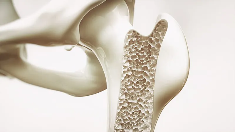CT beats MRI for spotting weak bones — and the numbers back it up
