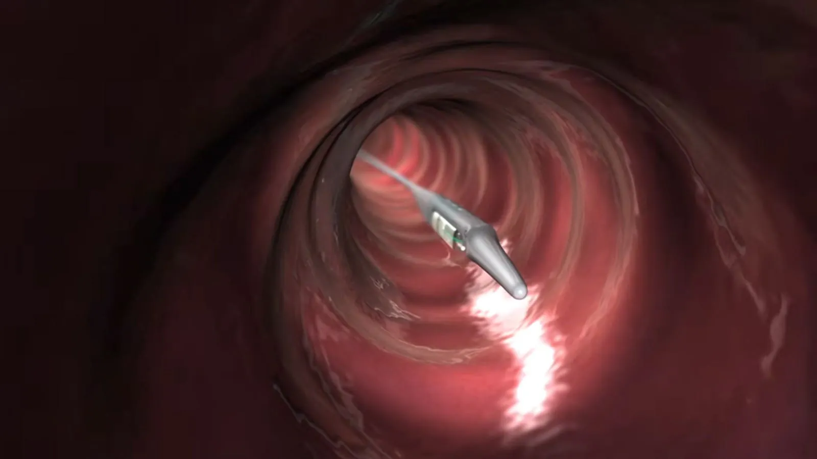 FDA flags Medtronic's acid reflux monitoring device for 184 serious injuries