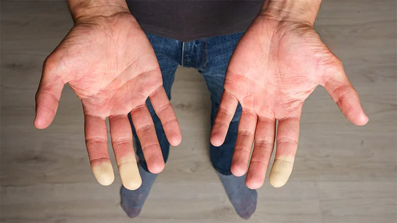 Vitamin B3 shows promise for improving capillary health in Raynaud phenomenon