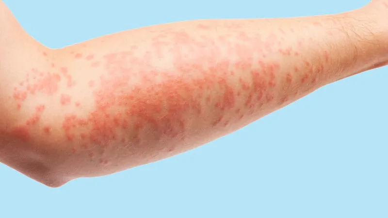 COVID pandemic linked to sharp, sustained drop in allergy diagnoses
