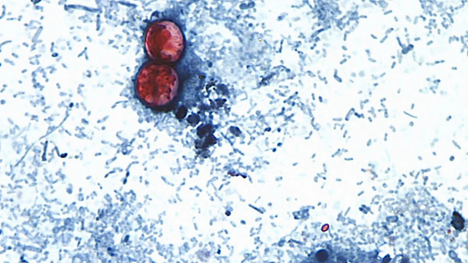 America's worst-ever Cyclospora outbreak tops 11,400 cases — and it's still spreading