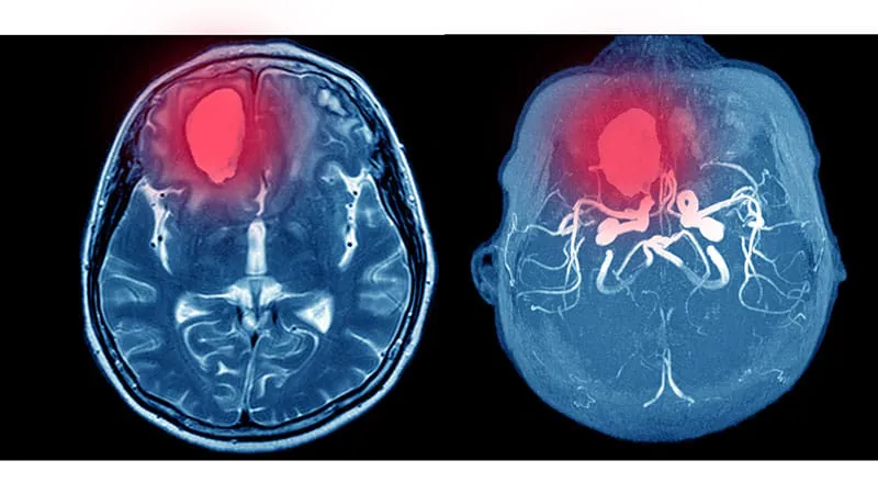 Edoxaban's ischemic stroke benefit wiped out by bleeding risk in AF patients with prior brain bleed