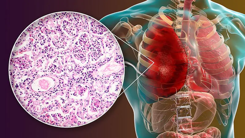 Transplant recipients face significantly higher mortality risk after infective endocarditis