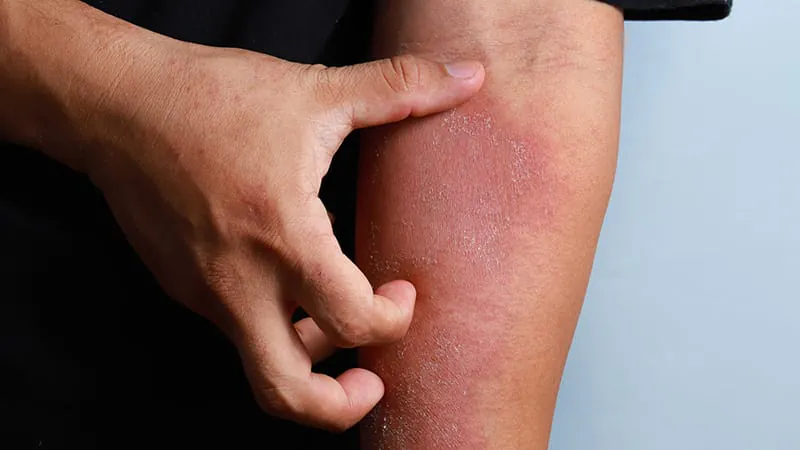 New drug rezpegaldesleukin shows strong results for atopic dermatitis in phase 2 trial