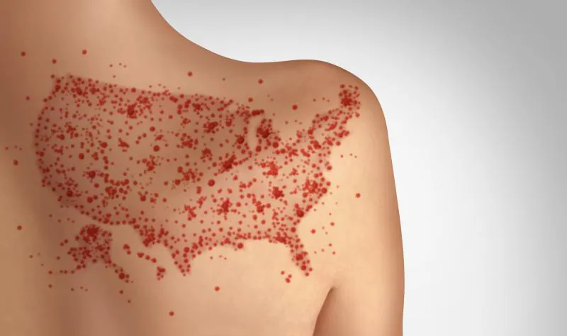 Pennsylvania measles outbreak turns deadly — and deeply disputed