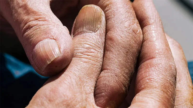 Upadacitinib shows lasting results in psoriatic arthritis patients who failed TNF inhibitor therapy