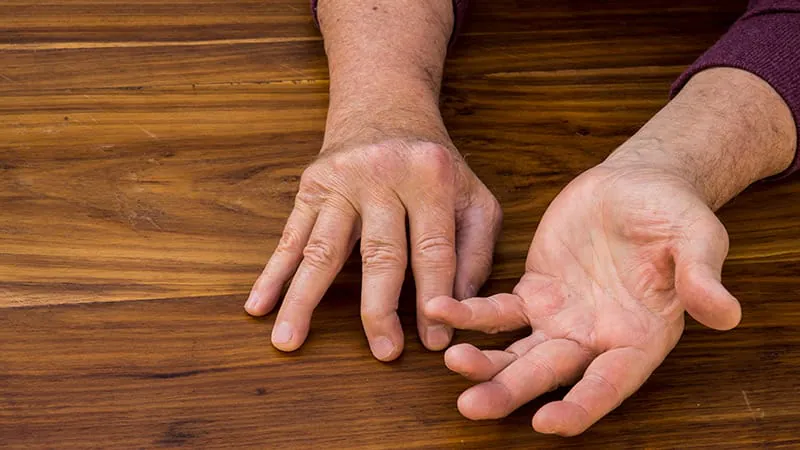 Tapering TNF inhibitors keeps psoriatic arthritis and axSpA patients in remission for 2 years