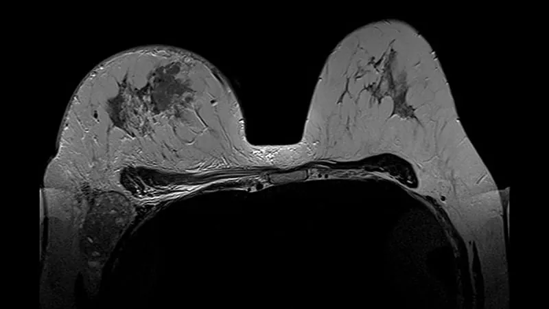 Most people have heard of inflammatory breast cancer — but can't recognize its warning signs