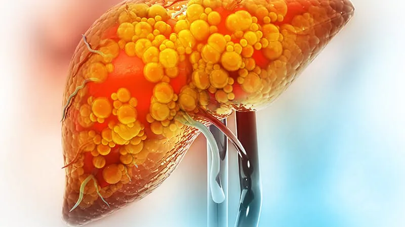 AI catches what radiologists miss: Fatty liver disease underreported on CT scans
