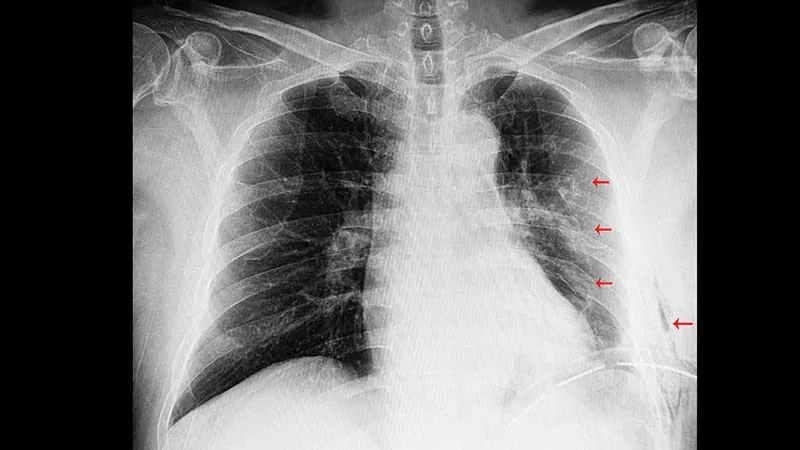 Small-bore chest tubes come out on top for nontraumatic pneumothorax