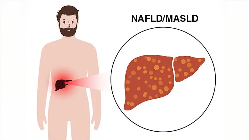 New drug cuts liver fat significantly in MASH patients