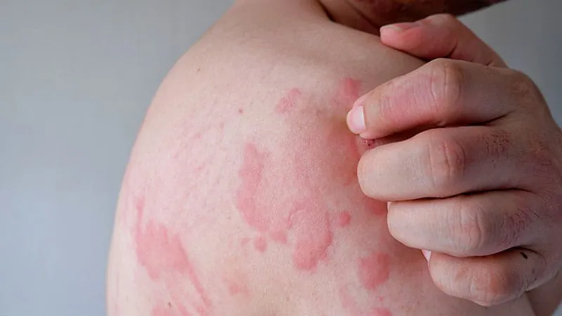 Standard cold test misses 1 in 3 cold urticaria patients, study finds