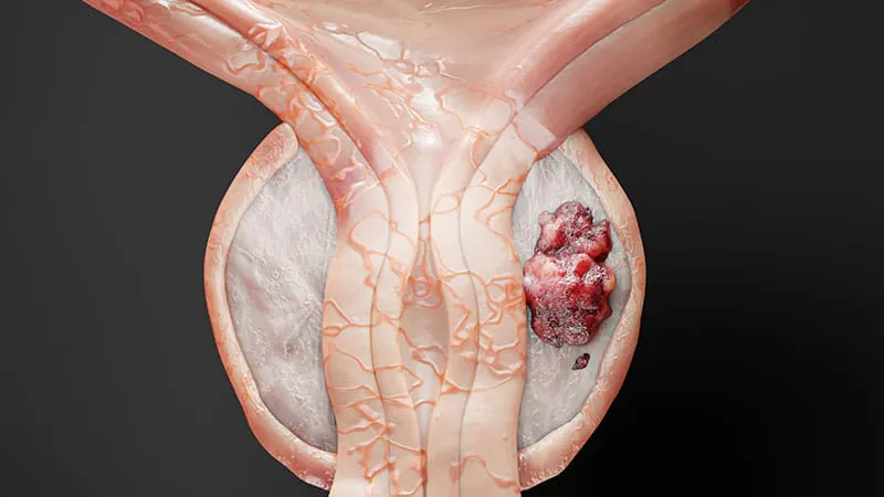 Higher radiation dose improves survival in high-risk prostate cancer — with a catch