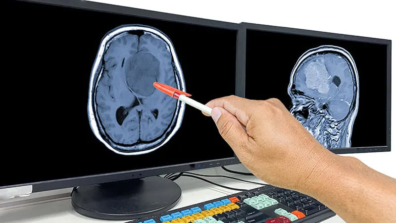 Faster radiation for glioblastoma backfires in phase 3 trial