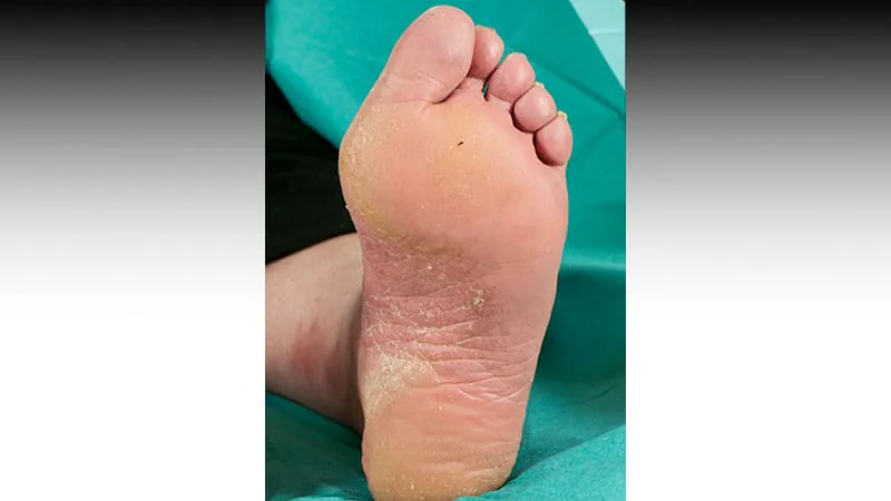 Topical diclofenac falls short in preventing chemo-related hand-foot syndrome