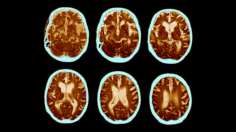 Early menopause linked to faster brain aging and cognitive decline, study finds