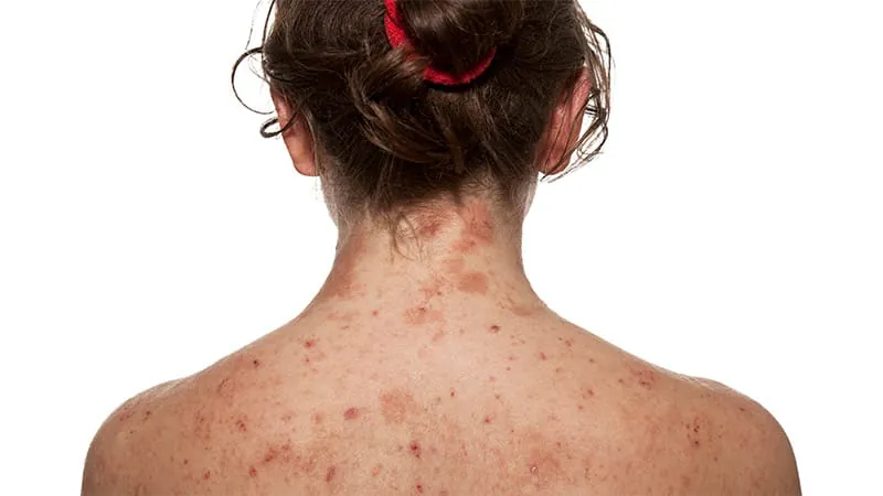 How biologics transformed atopic dermatitis care — and what's still missing