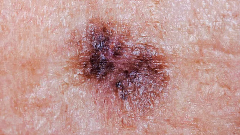 Triple combo therapy extends survival in BRAF-mutant melanoma — but just misses the mark