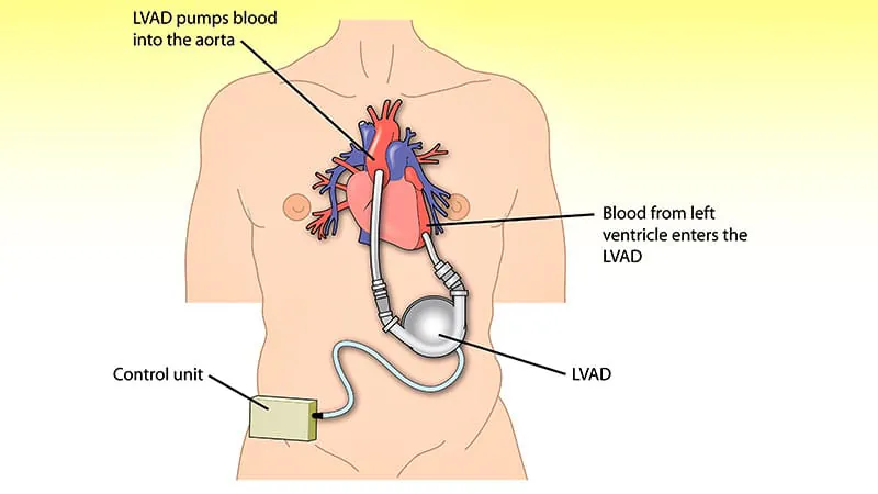 1 in 5 kids on long-term heart pumps are still waiting for a transplant at 2 years