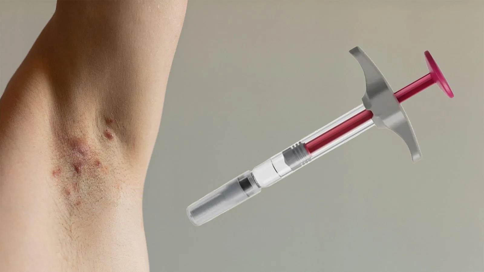 Not all psoriasis biologics are equal when it comes to a surprising skin side effect