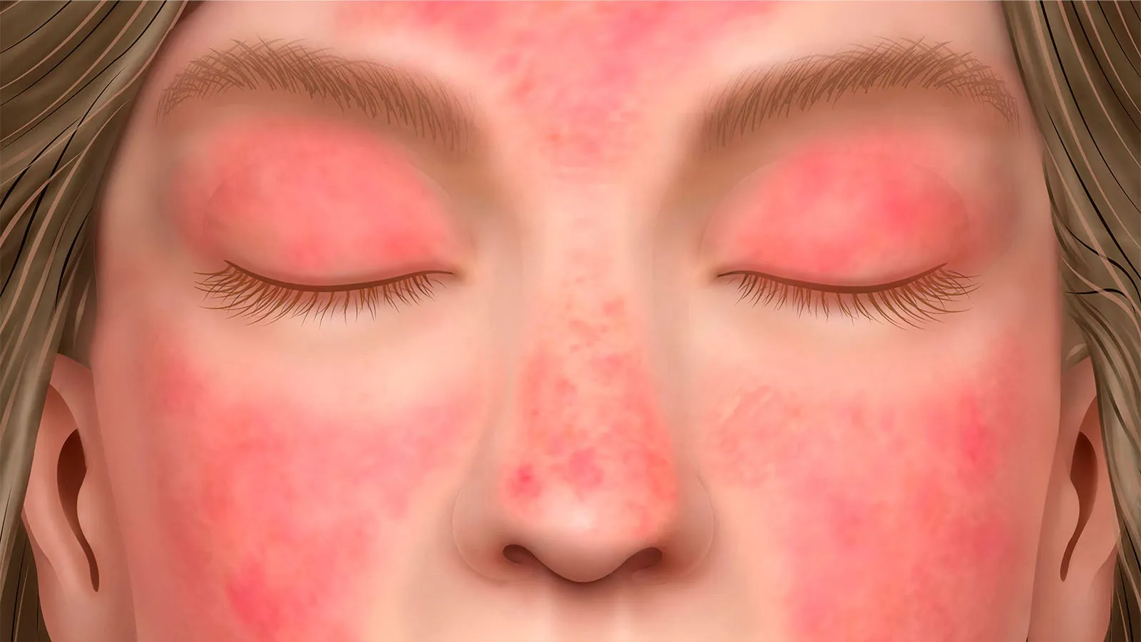 First oral drug for dermatomyositis delivers dramatic skin improvements in phase 3 trial