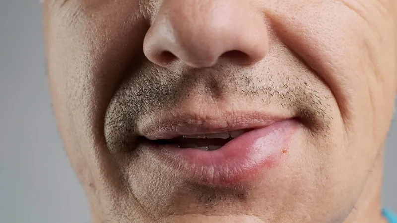Statins may double the risk of severe allergic reactions to bee and wasp stings