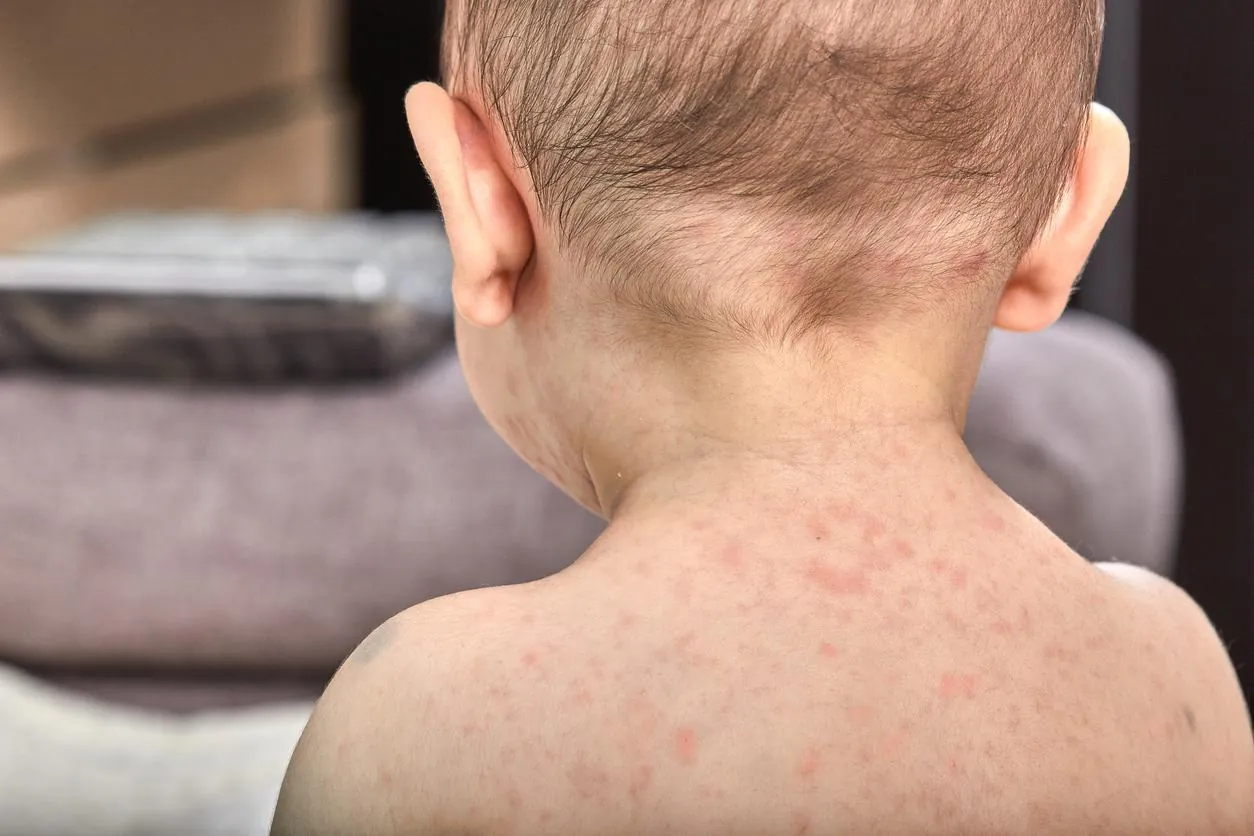 Pennsylvania's measles outbreak deepens as coroner confirms second child death amid political controversy