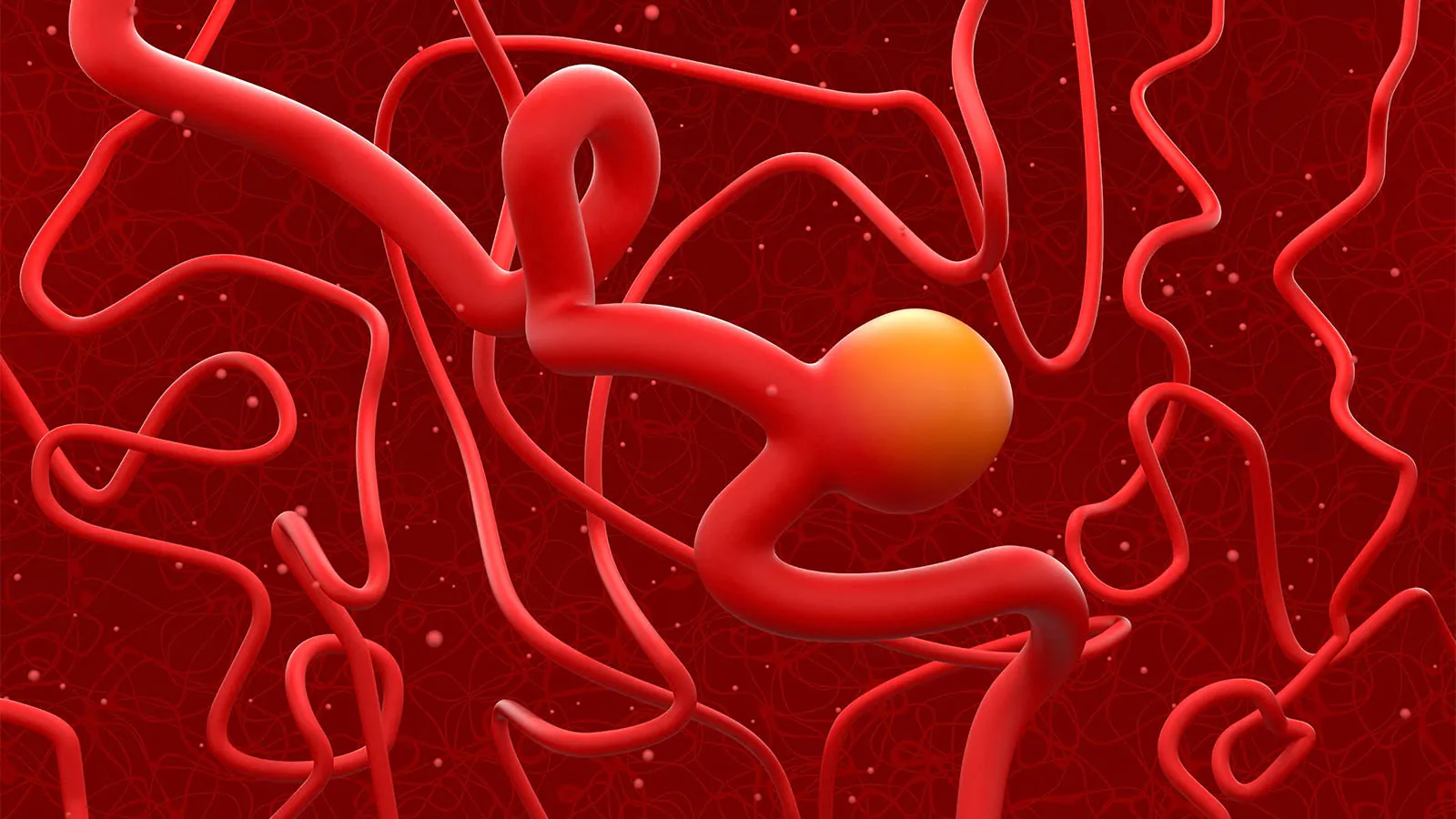 Brain aneurysms are more common than we thought — and it's not just better imaging to blame